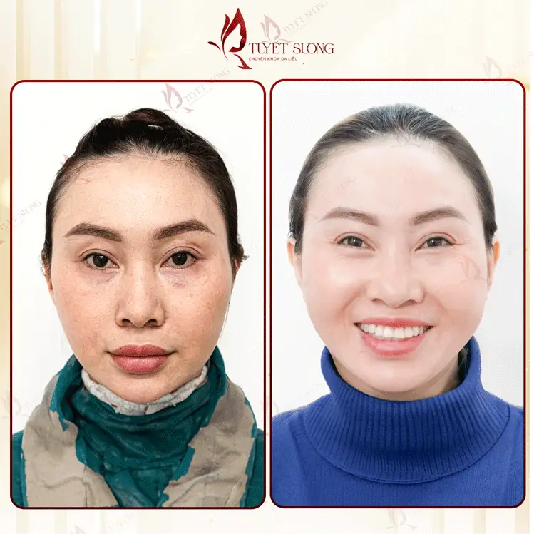 Phòng Khám Da Liễu Tuyết Sương – Chuyên Điều Trị Nám Da