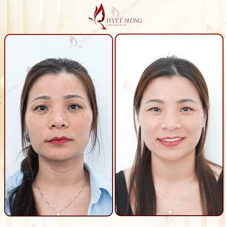 Phòng Khám Da Liễu Tuyết Sương – Chuyên Điều Trị Nám Da