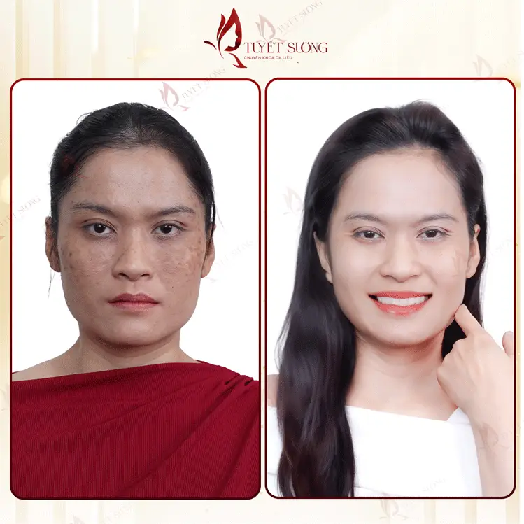 Phòng Khám Da Liễu Tuyết Sương – Chuyên Điều Trị Nám Da