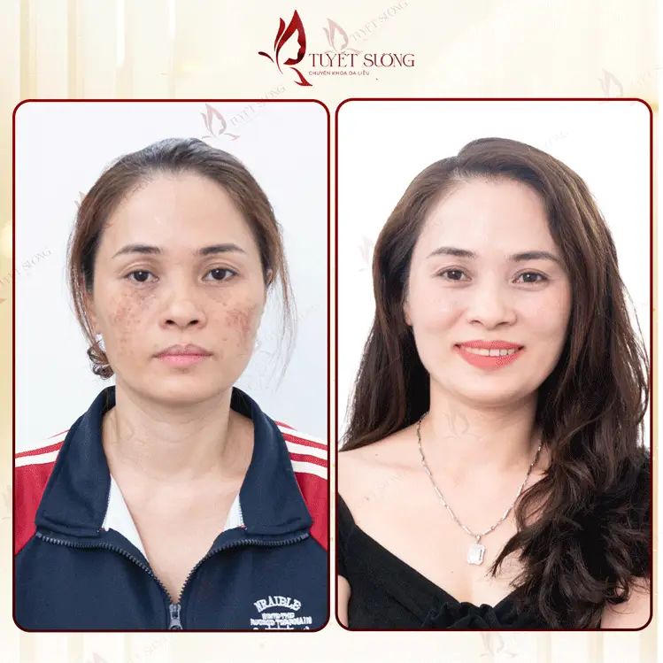 Phòng Khám Da Liễu Tuyết Sương – Chuyên Điều Trị Nám Da