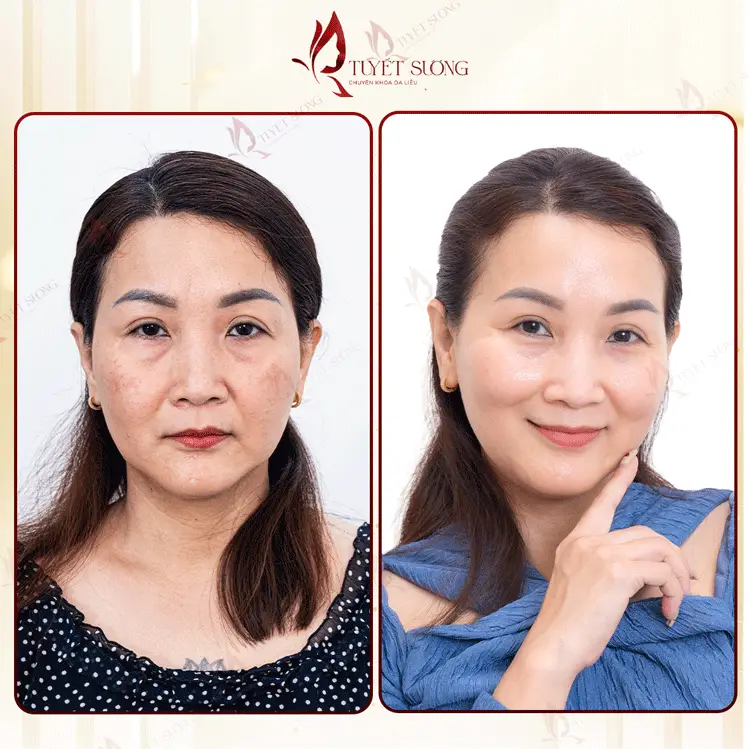 Phòng Khám Da Liễu Tuyết Sương – Chuyên Điều Trị Nám Da