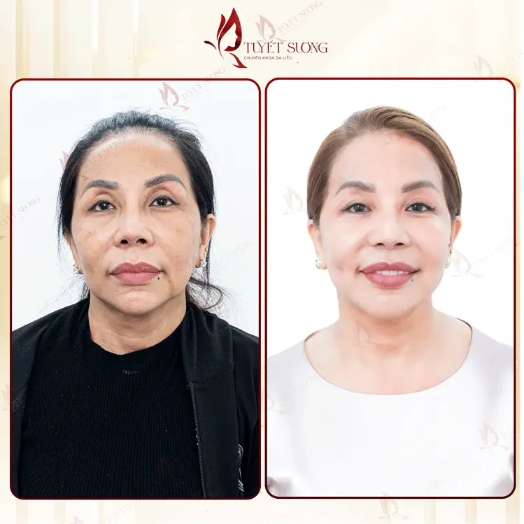 Phòng Khám Da Liễu Tuyết Sương – Chuyên Điều Trị Nám Da