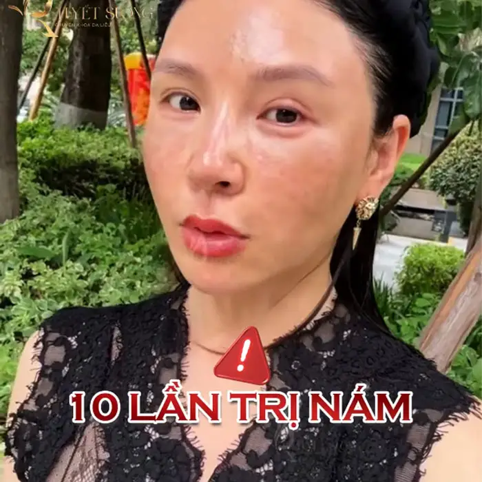 Phòng Khám Da Liễu Tuyết Sương – Chuyên Điều Trị Nám Da