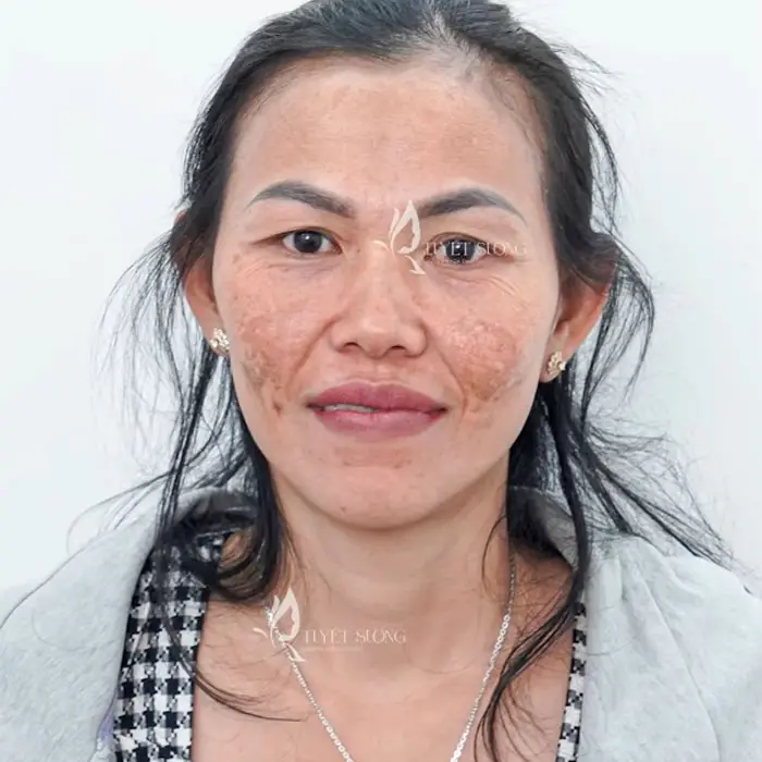 Phòng Khám Da Liễu Tuyết Sương – Chuyên Điều Trị Nám Da