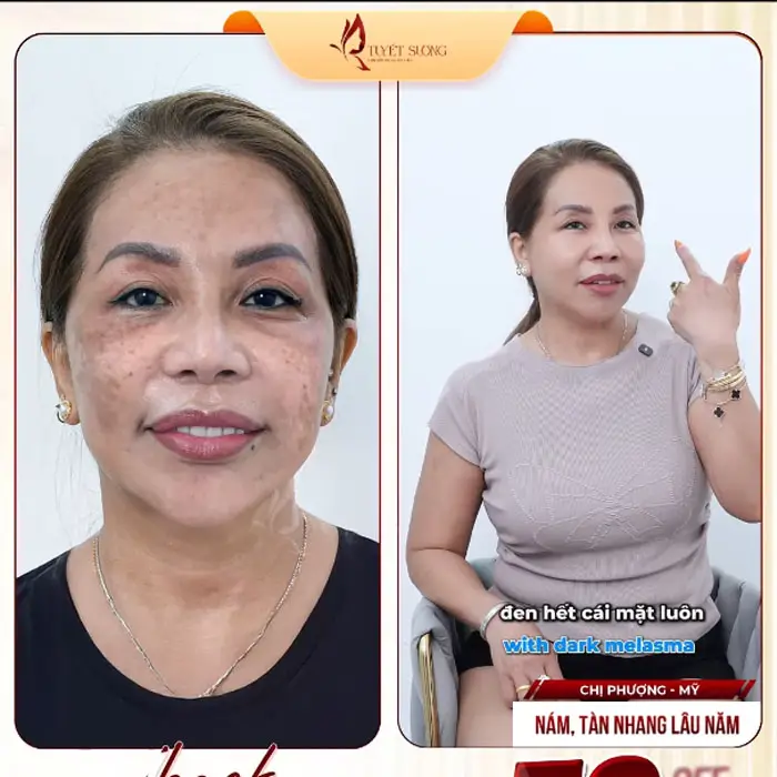 Phòng Khám Da Liễu Tuyết Sương – Chuyên Điều Trị Nám Da