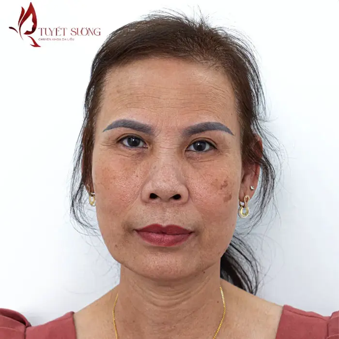 Phòng Khám Da Liễu Tuyết Sương – Chuyên Điều Trị Nám Da