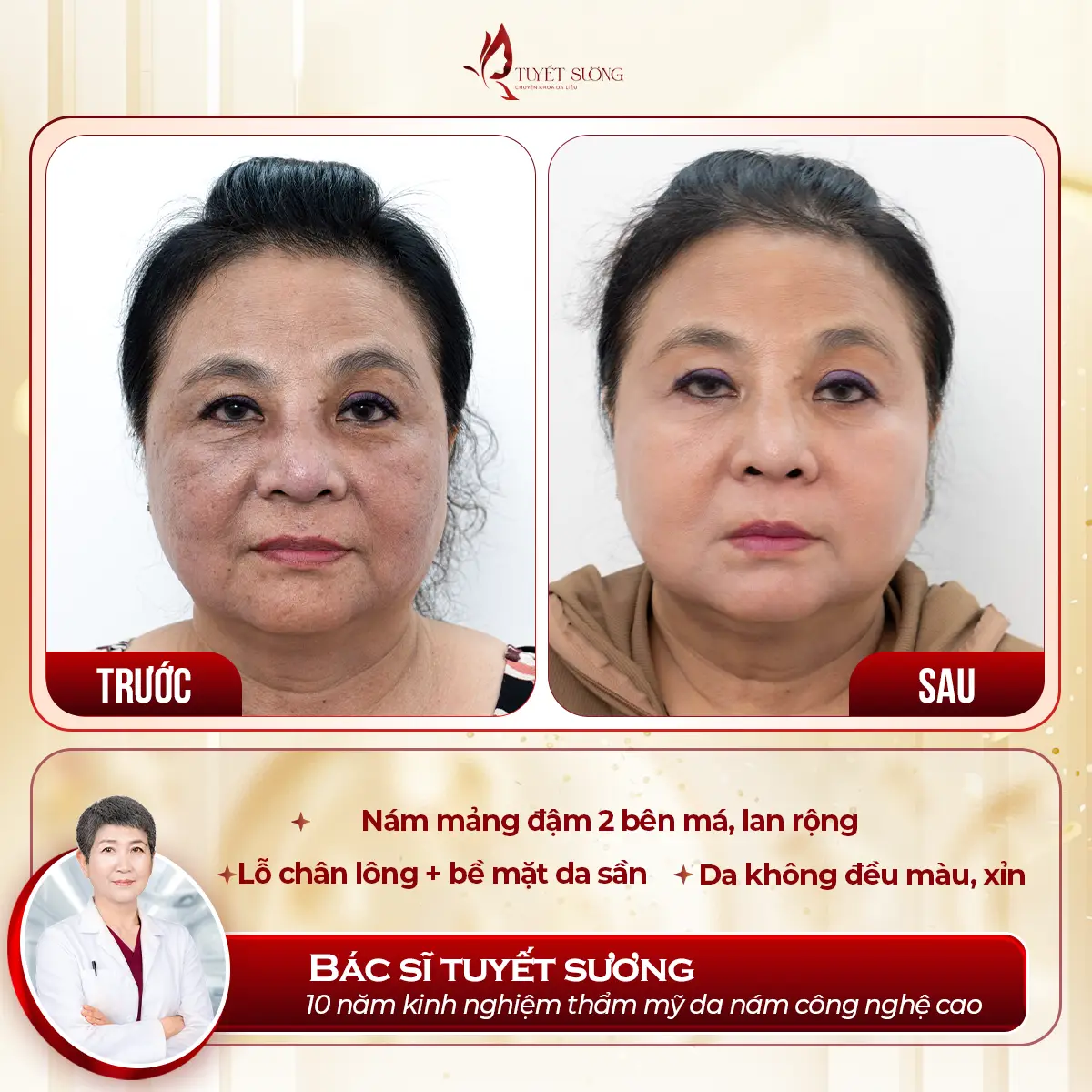 Video – Hình Ảnh Kết Quả Khách Hàng Điều Trị Nám Da