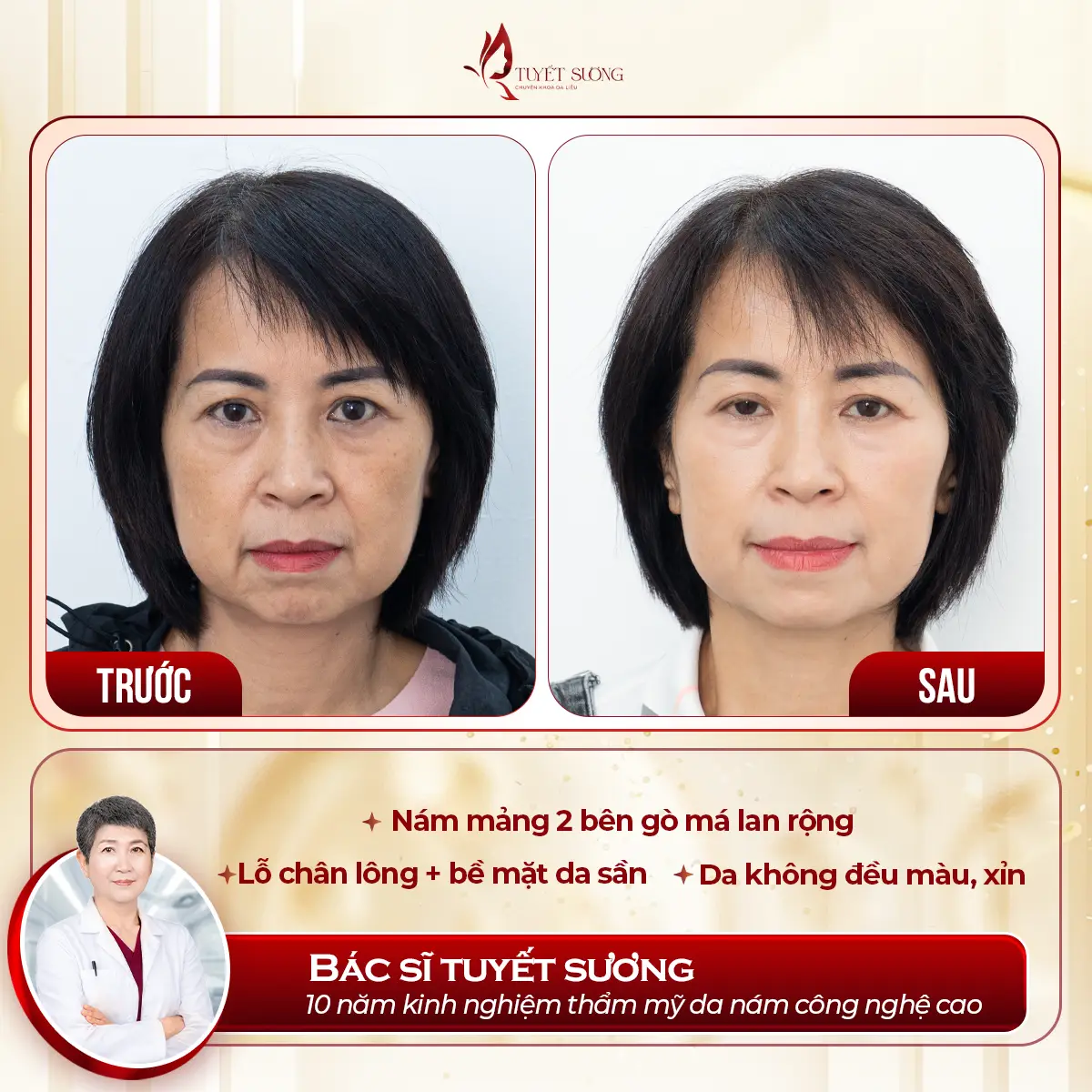 Video – Hình Ảnh Kết Quả Khách Hàng Điều Trị Nám Da