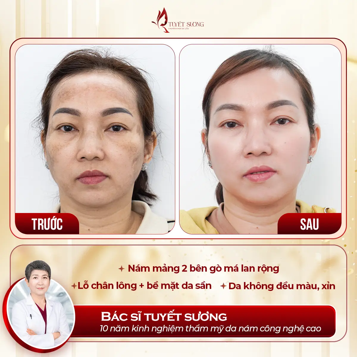Video – Hình Ảnh Kết Quả Khách Hàng Điều Trị Nám Da