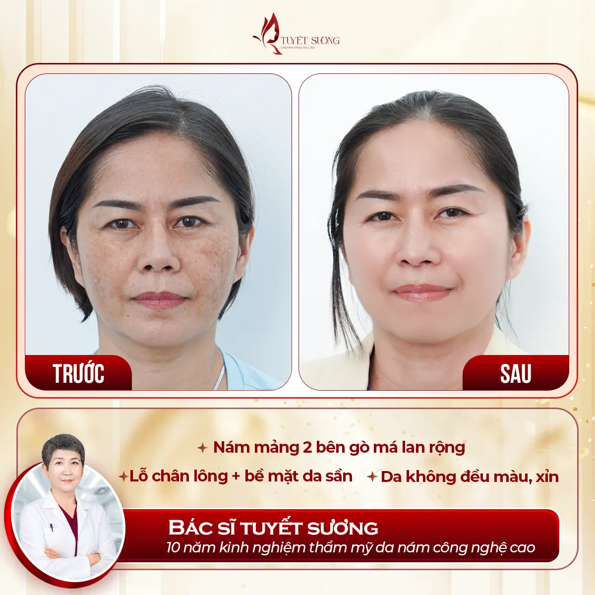 Video – Hình Ảnh Kết Quả Khách Hàng Điều Trị Nám Da