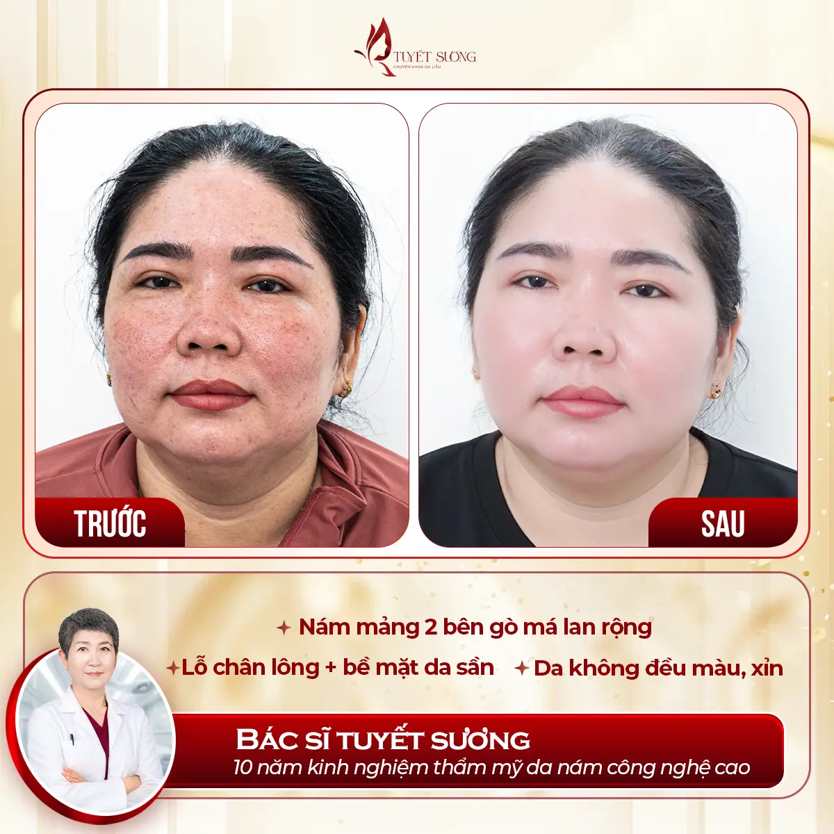 Video – Hình Ảnh Kết Quả Khách Hàng Điều Trị Nám Da