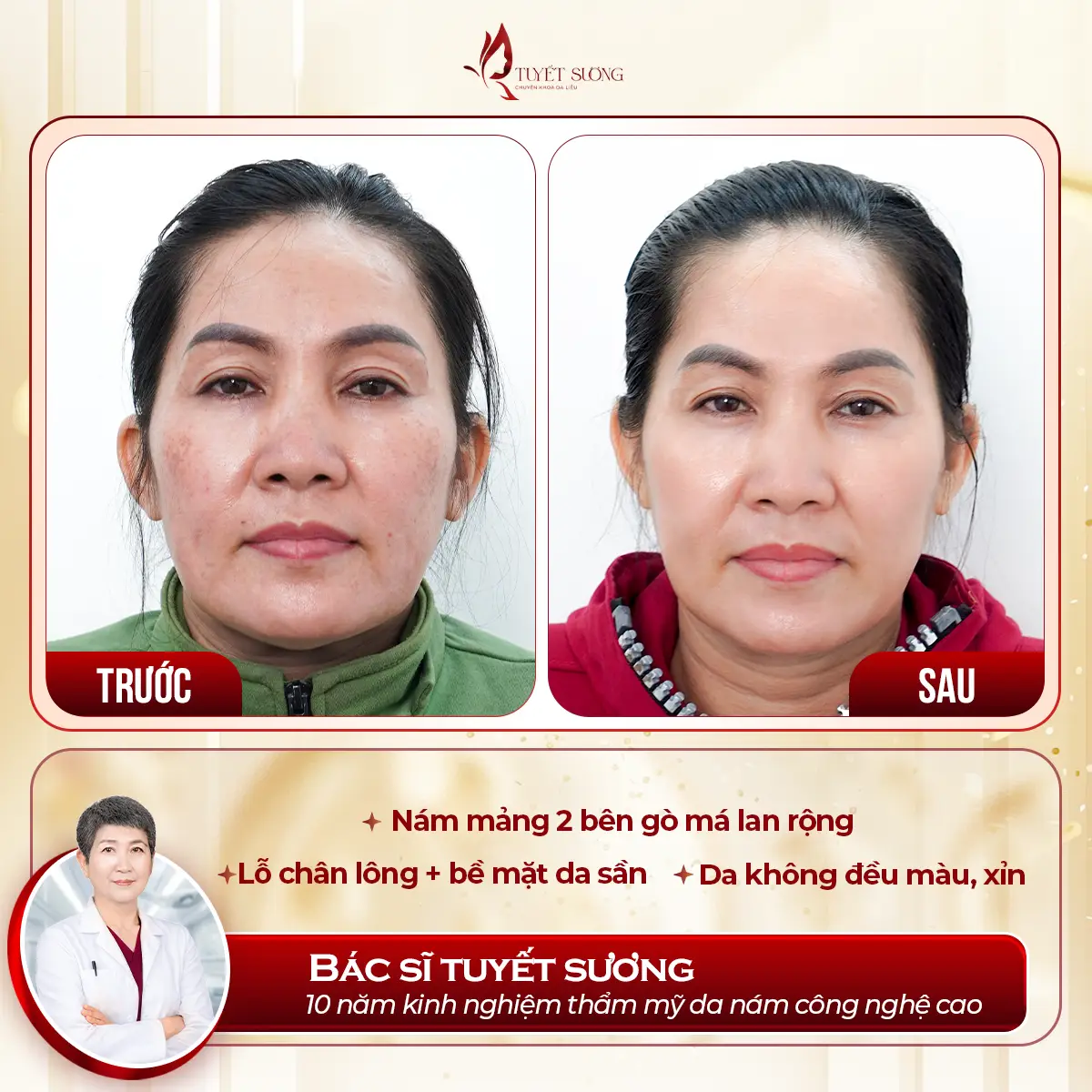 Video – Hình Ảnh Kết Quả Khách Hàng Điều Trị Nám Da