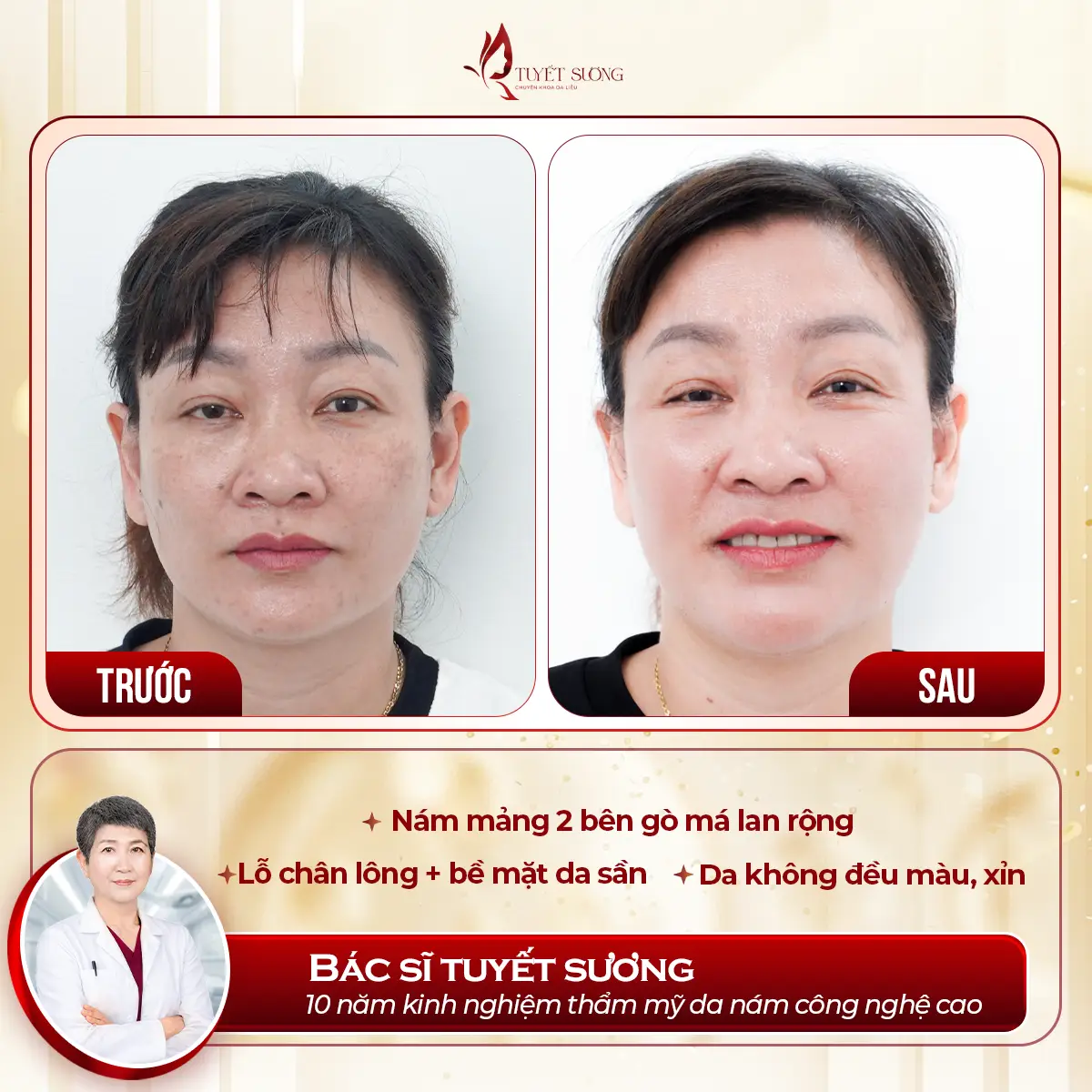 Video – Hình Ảnh Kết Quả Khách Hàng Điều Trị Nám Da