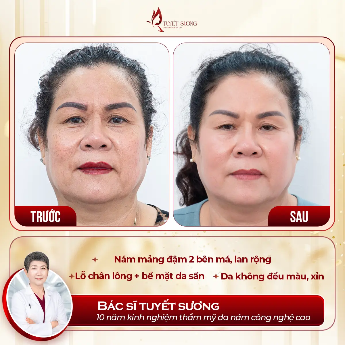 Video – Hình Ảnh Kết Quả Khách Hàng Điều Trị Nám Da