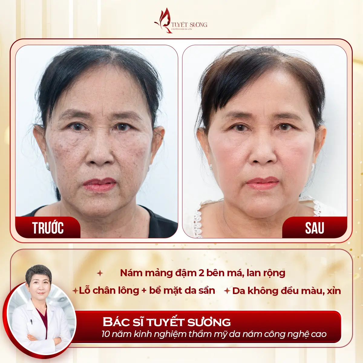 Video – Hình Ảnh Kết Quả Khách Hàng Điều Trị Nám Da