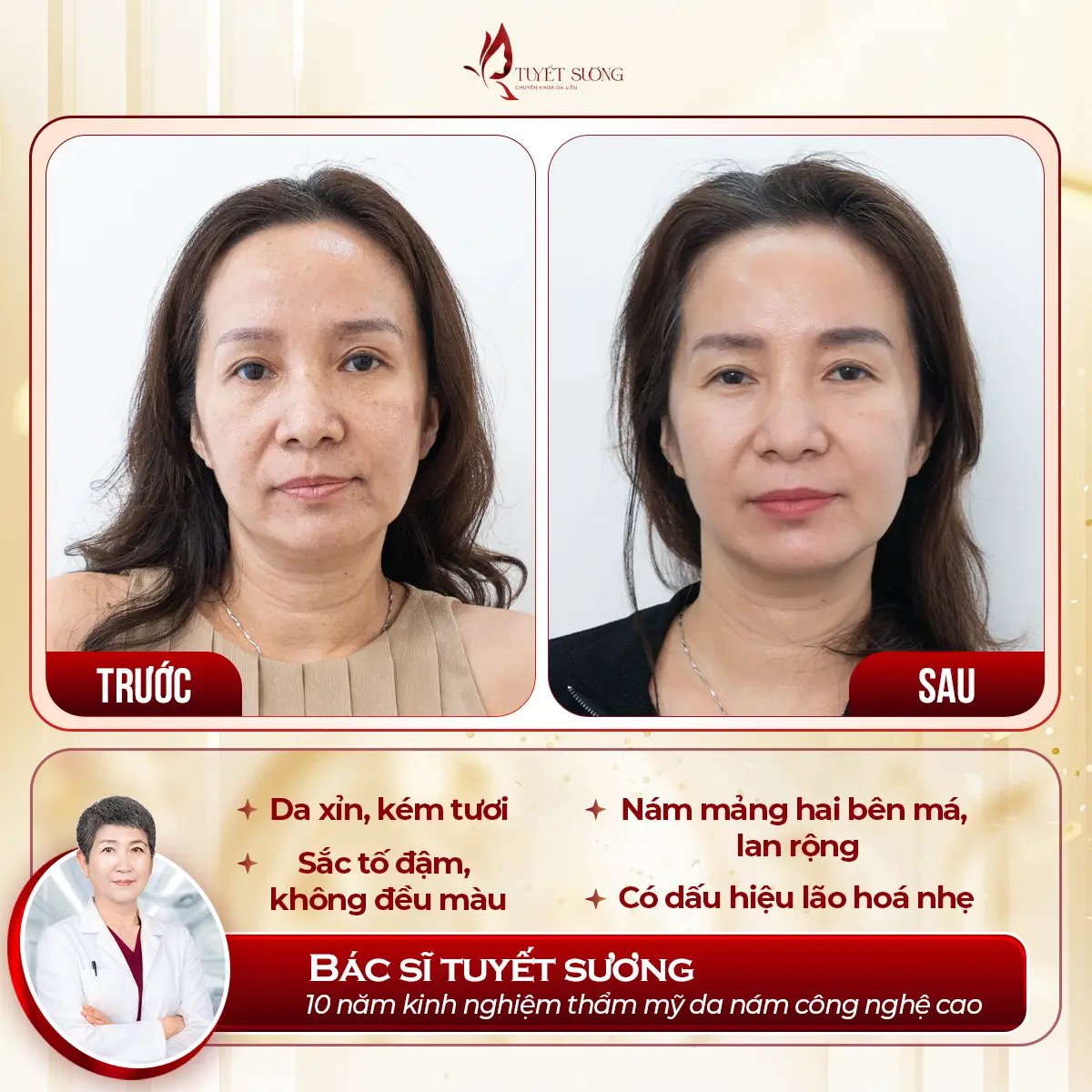 Video – Hình Ảnh Kết Quả Khách Hàng Điều Trị Nám Da