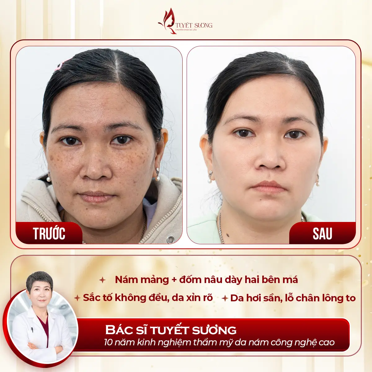 Video – Hình Ảnh Kết Quả Khách Hàng Điều Trị Nám Da