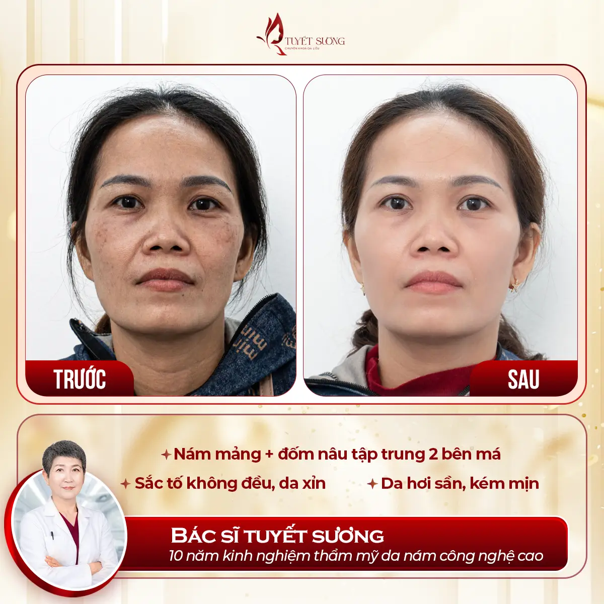 Video – Hình Ảnh Kết Quả Khách Hàng Điều Trị Nám Da