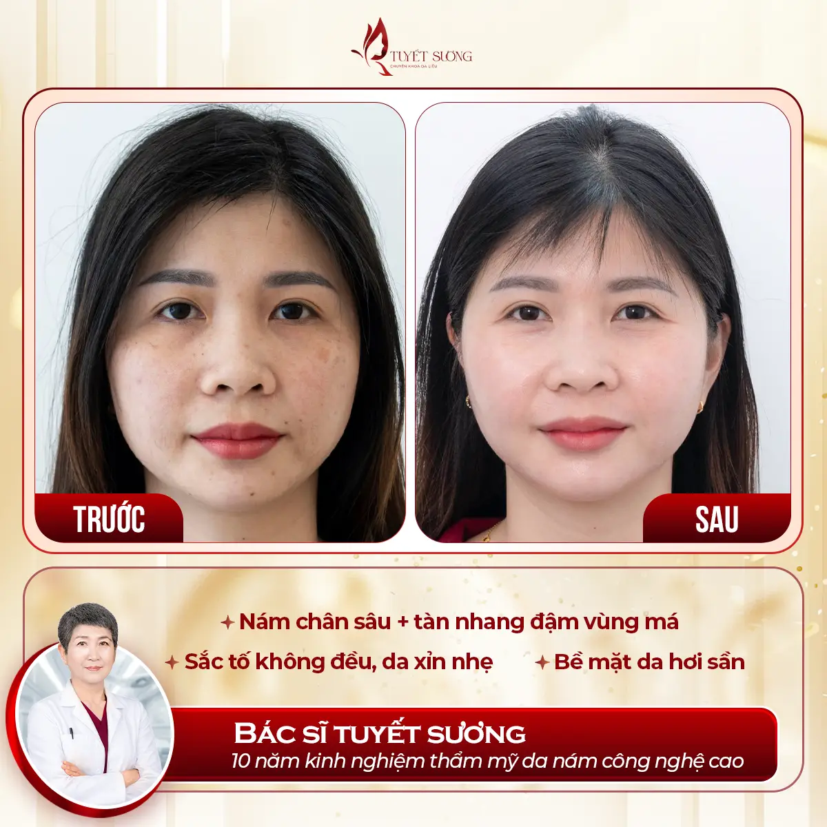 Video – Hình Ảnh Kết Quả Khách Hàng Điều Trị Nám Da
