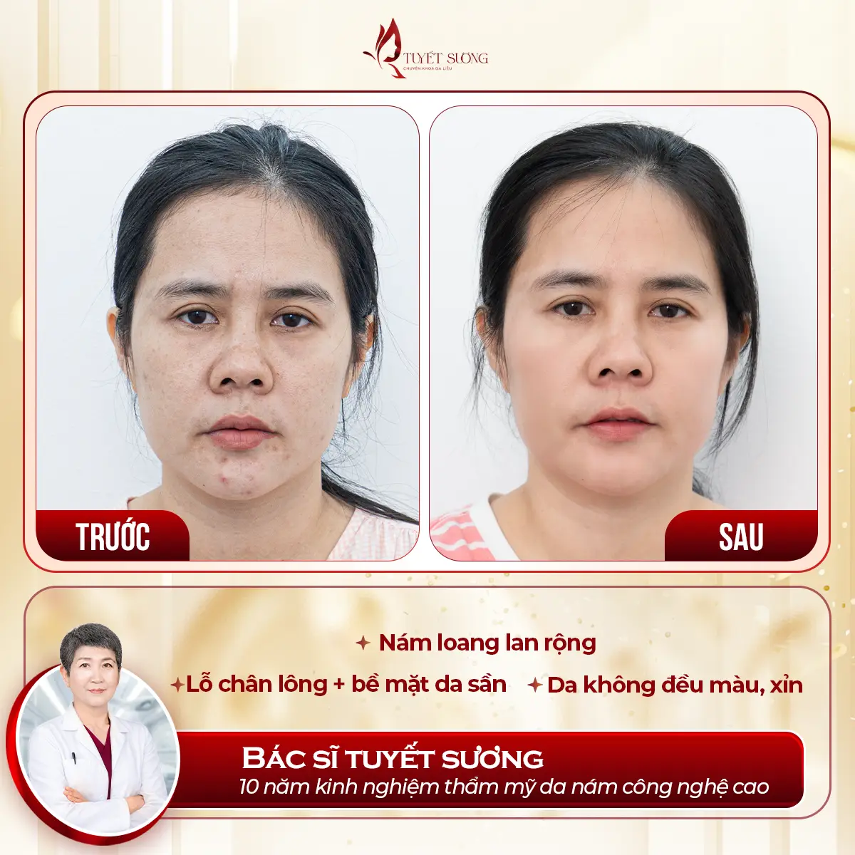 Video – Hình Ảnh Kết Quả Khách Hàng Điều Trị Nám Da