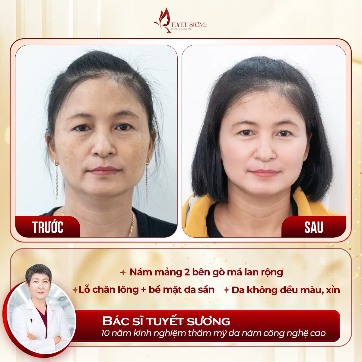 Video – Hình Ảnh Kết Quả Khách Hàng Điều Trị Nám Da